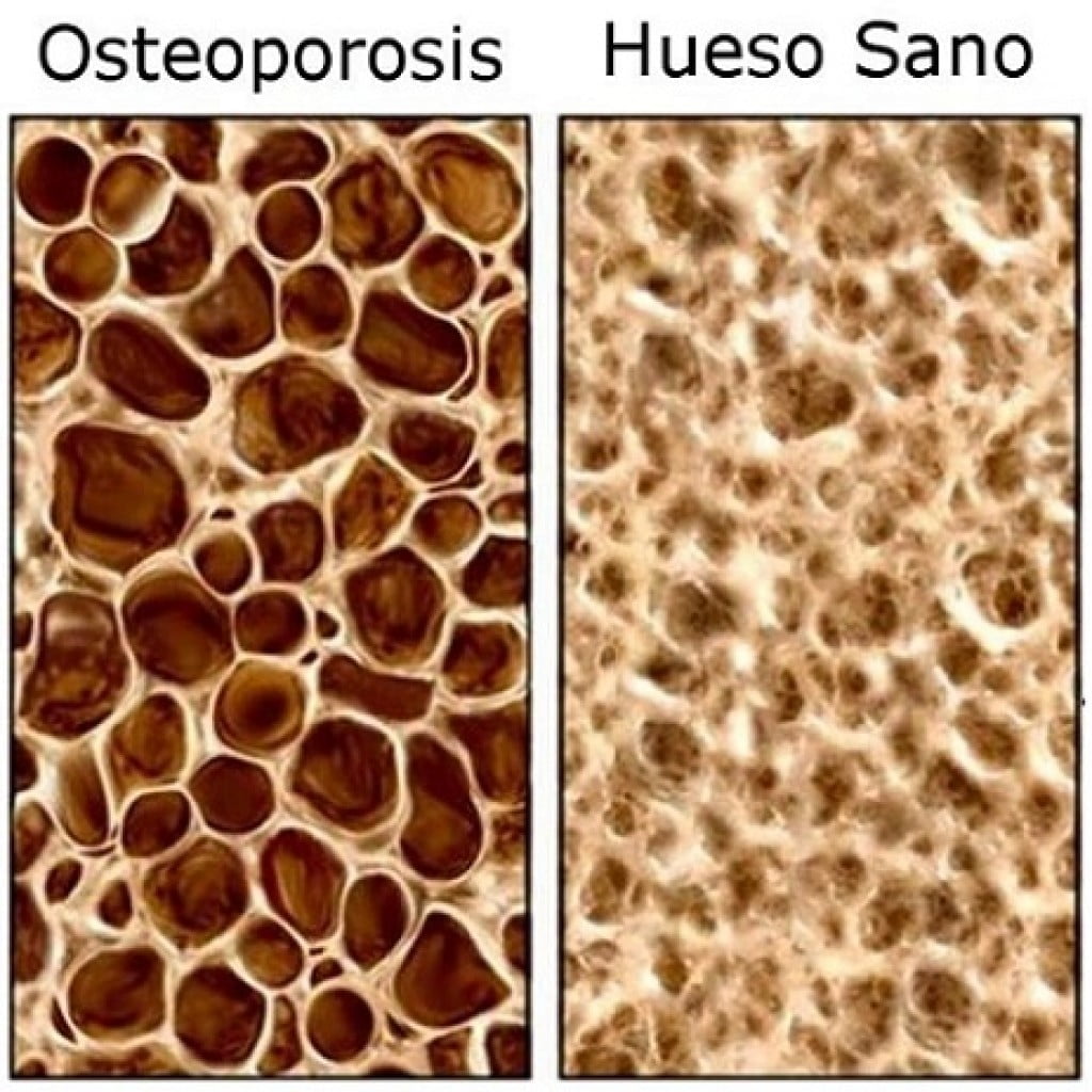 osteoporosis dieta